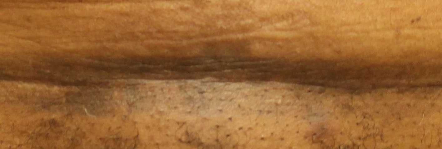 Removal of Keloids - picture after