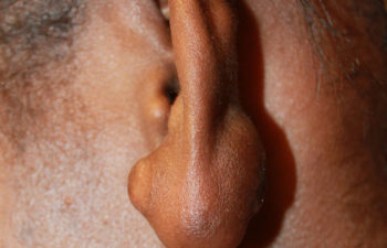 Removal of Keloids - picture before
