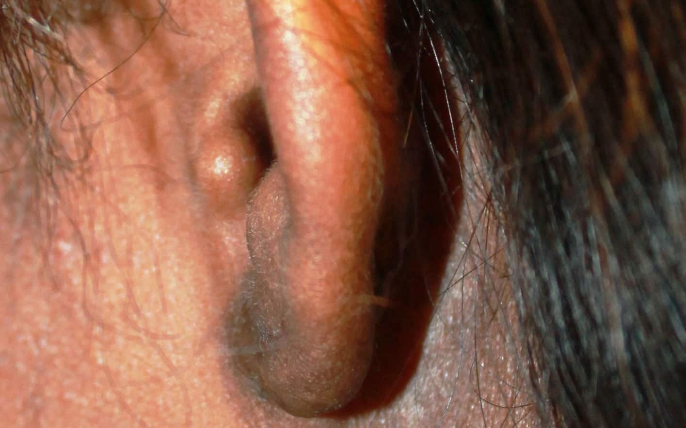 Removal of Keloids - picture after