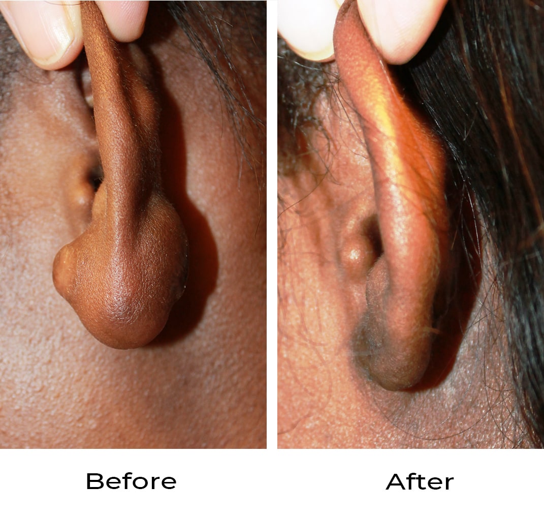 Removal of Keloids before and after photo