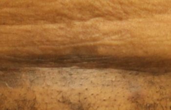 Removal of pubis - picture after