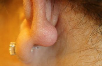 Removal of keloid - picture before