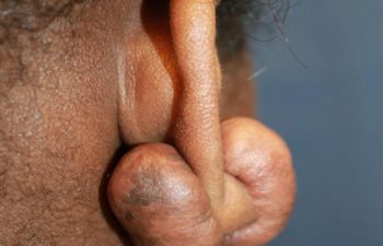 Removal of keloid - picture before