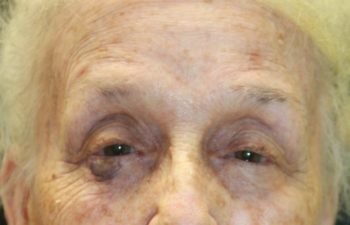 Removal of keloid - picture before