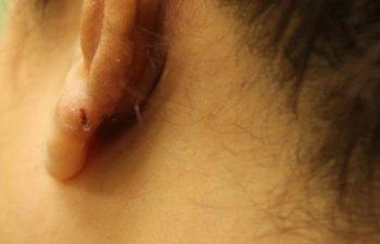 Removal of keloid - picture after