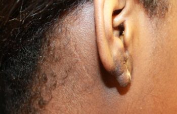 Removal of keloid - picture after