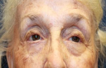 Removal of keloid - picture after