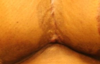 Removal of Keloids - picture after