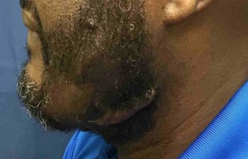 Removal of keloid - picture after
