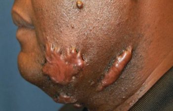 Removal of keloid - picture before