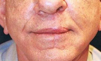 Removal of keloid - picture after