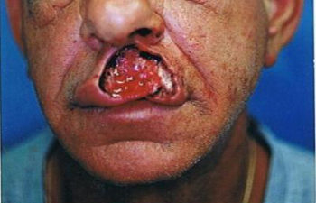 Removal of keloid - picture before
