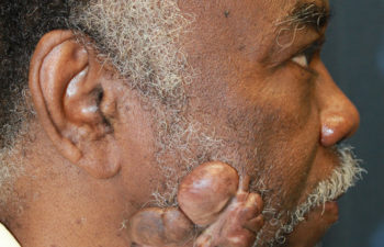Removal of keloid - picture before