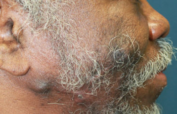 Removal of keloid - picture after
