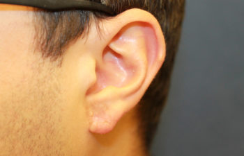 Removal of keloid - picture after