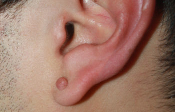 Removal of keloid - picture before
