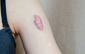 keloid scar on shoulder of woman