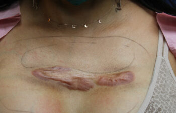 Removal of keloid - photo before