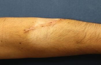 Removal of keloid - photo after