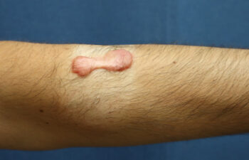 Removal of keloid - photo before