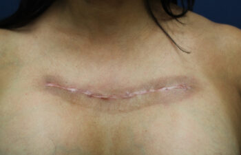 Removal of keloid - photo after